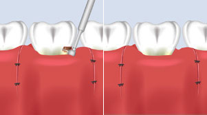 crown-lengthening-2