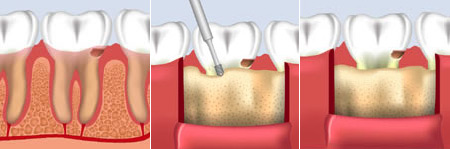 crown-lengthening