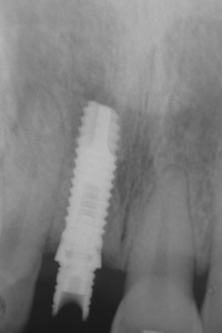 dental-implants