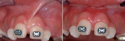 frenectomy