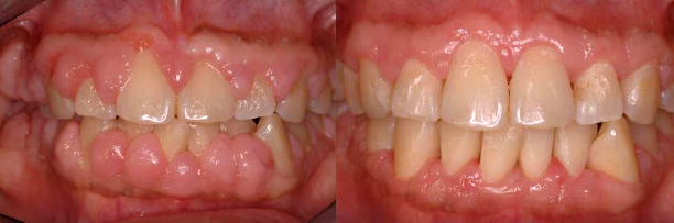 Gingival Overgrowth