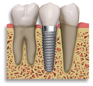 implant-between-2-teeth