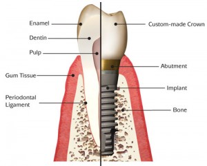 implant_anatomy