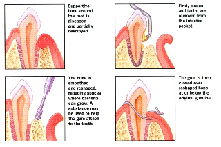 osseous