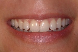 periodontal-cosmetic-2