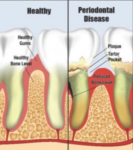 periodontal-disease-3