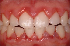 periodontal-disease-4