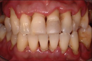 periodontal-disease-5