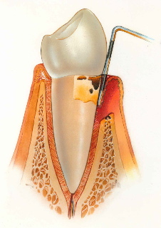 periodontal-disease-6