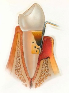 periodontal-disease-7