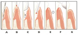 periolase-steps